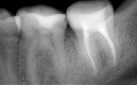 2014 - kontrola RVG - brak zmian zapalnych w okolicy wierzchołków korzeni zęba trzonowego. Ząb uratowany! Pacjentka szczęśliwa!