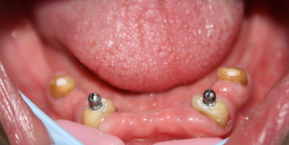 Protetyka - Zatrzaski zamontowane w korzeniach dolnych zębów [:de]Zatrzaski zamontowane w korzeniach dolnych zębów[:en]Zatrzaski zamontowane w korzeniach dolnych zębów